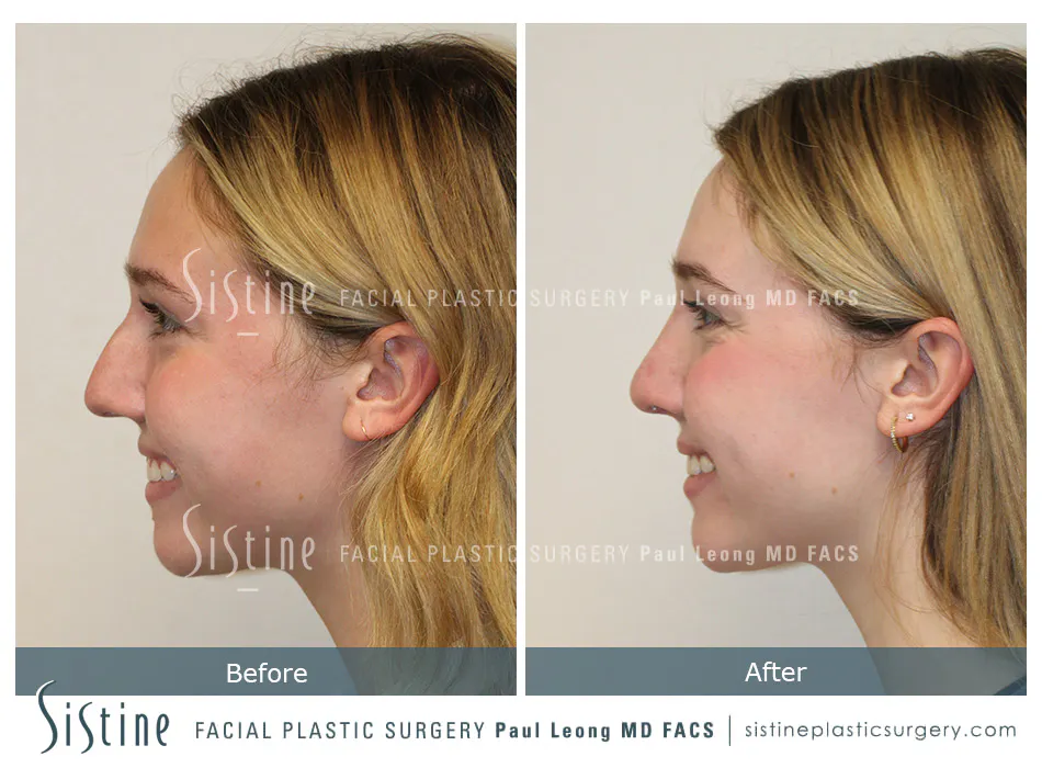 Rhinoplasty Before and After | Leong Facial Plastic Surgery