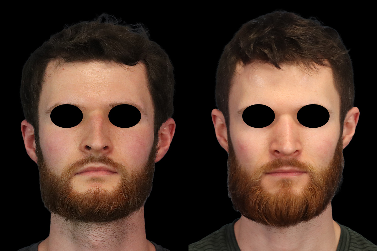 Rhinoplasty Before and After | Leong Facial Plastic Surgery