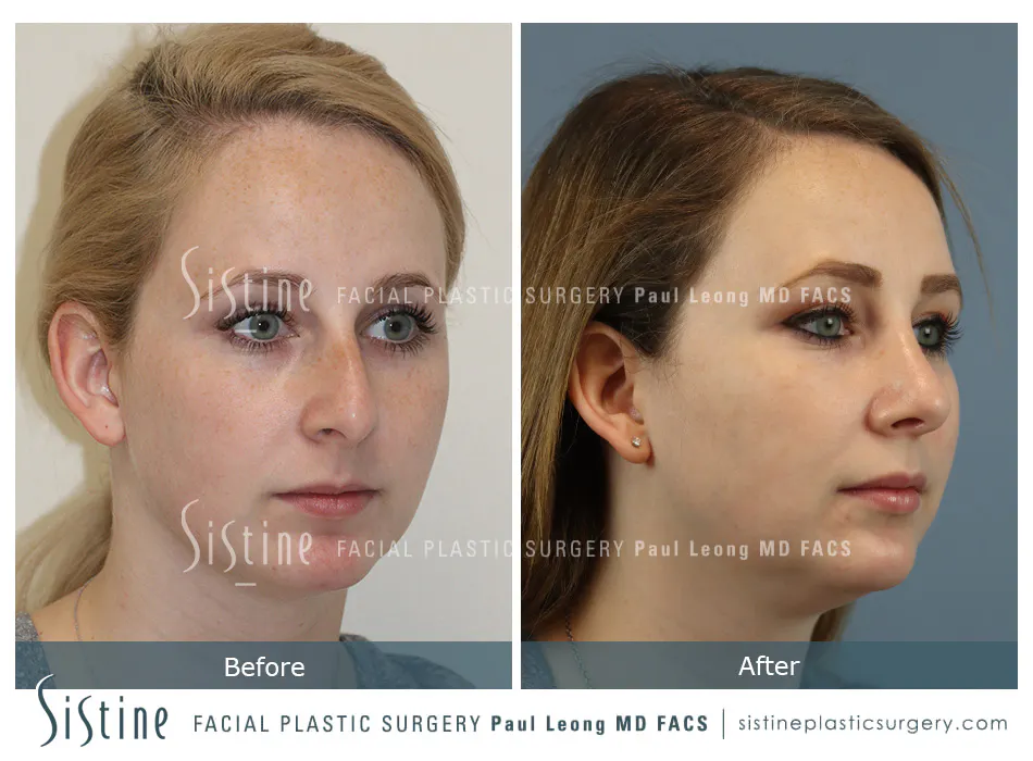 Rhinoplasty Before and After | Leong Facial Plastic Surgery