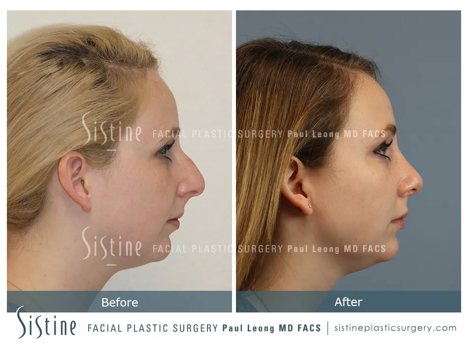 Rhinoplasty Before and After | Leong Facial Plastic Surgery