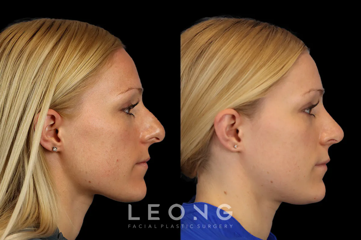 Rhinoplasty Before and After | Leong Facial Plastic Surgery