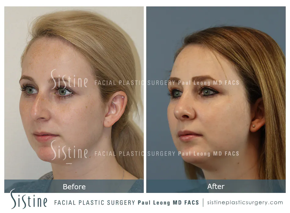 Rhinoplasty Before and After | Leong Facial Plastic Surgery