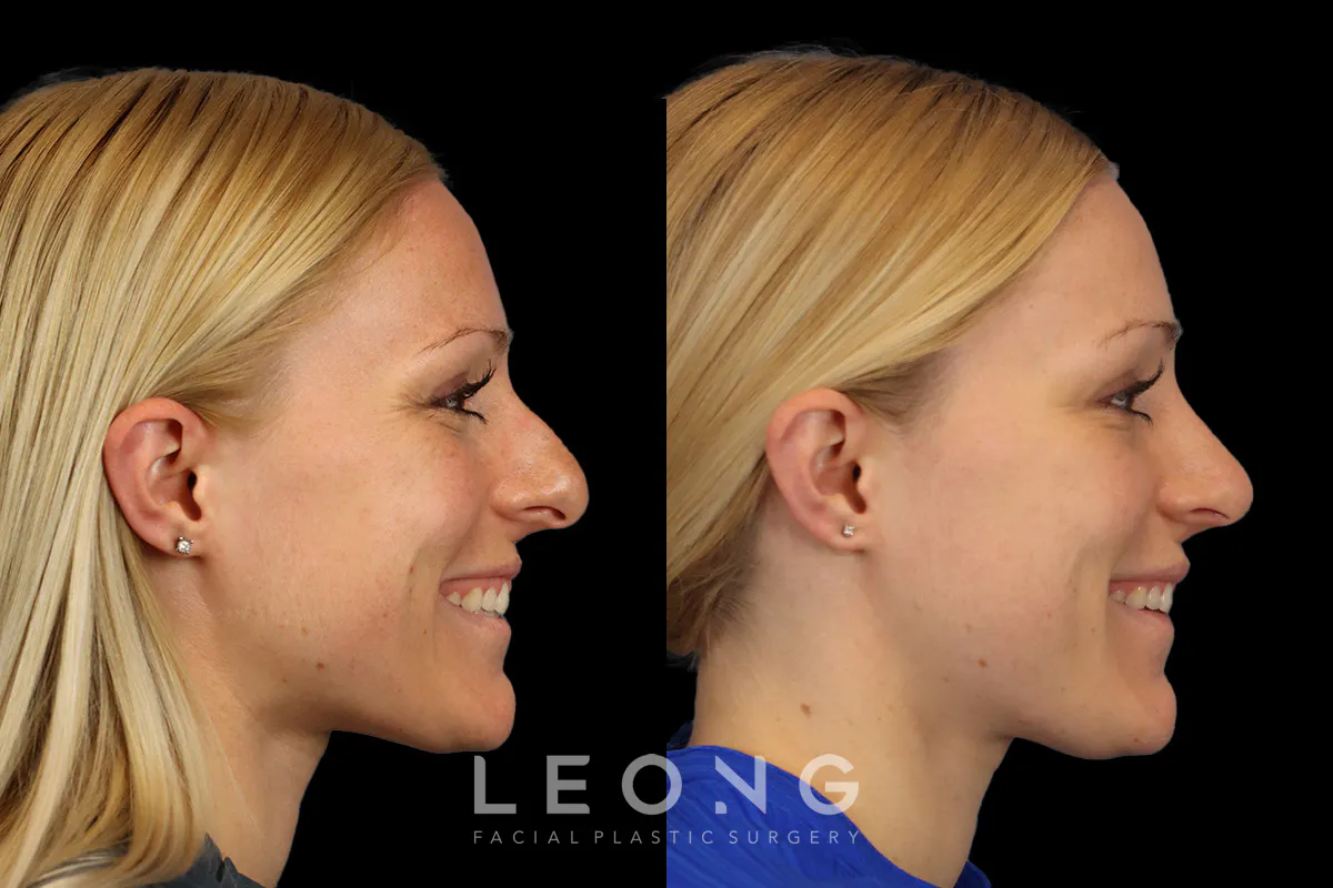 Rhinoplasty Before and After | Leong Facial Plastic Surgery