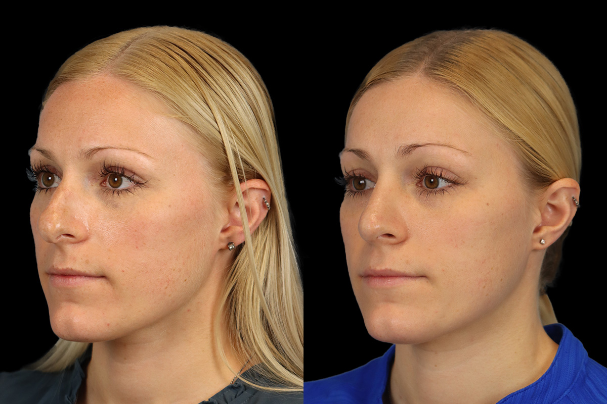 Rhinoplasty Before and After | Leong Facial Plastic Surgery