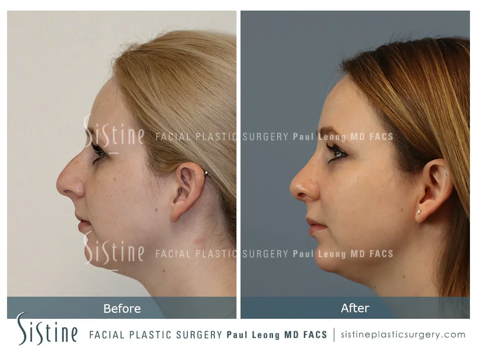 Rhinoplasty Before and After | Leong Facial Plastic Surgery