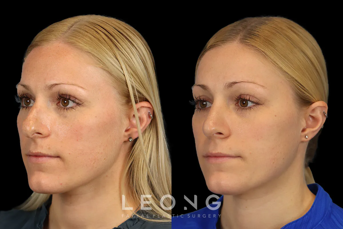 Rhinoplasty Before and After | Leong Facial Plastic Surgery