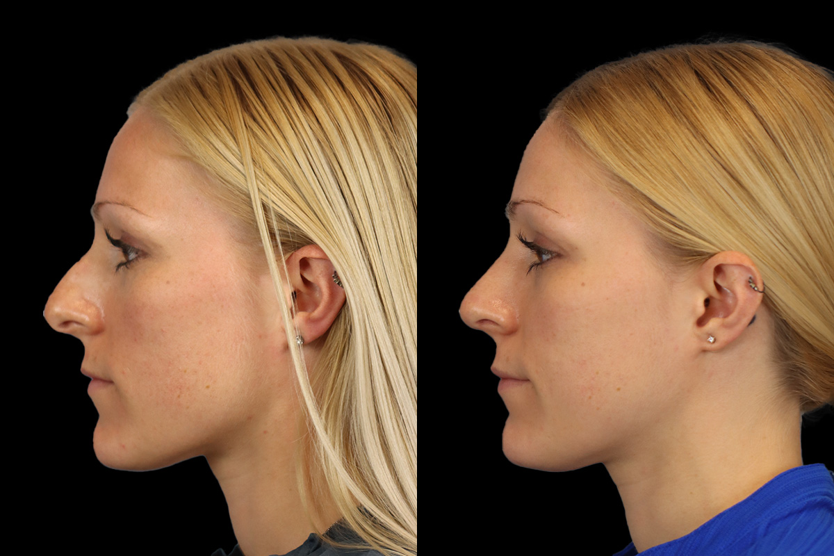 Rhinoplasty Before and After | Leong Facial Plastic Surgery