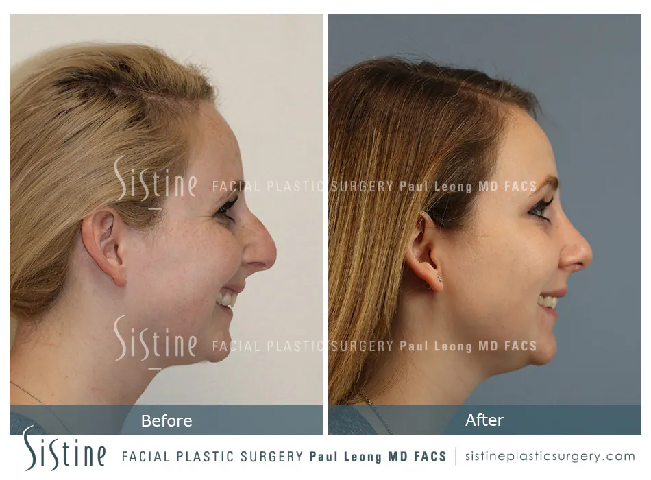 Rhinoplasty Before and After | Leong Facial Plastic Surgery