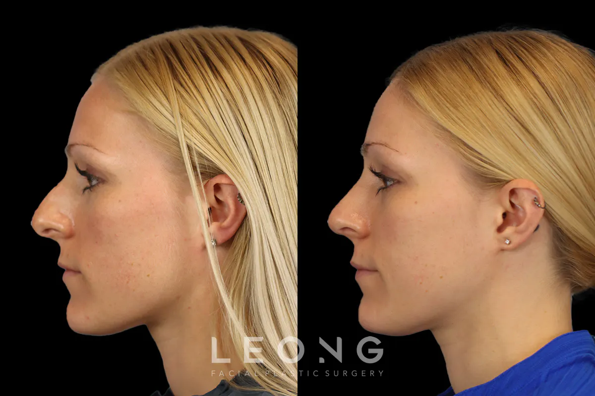 Rhinoplasty Before and After | Leong Facial Plastic Surgery