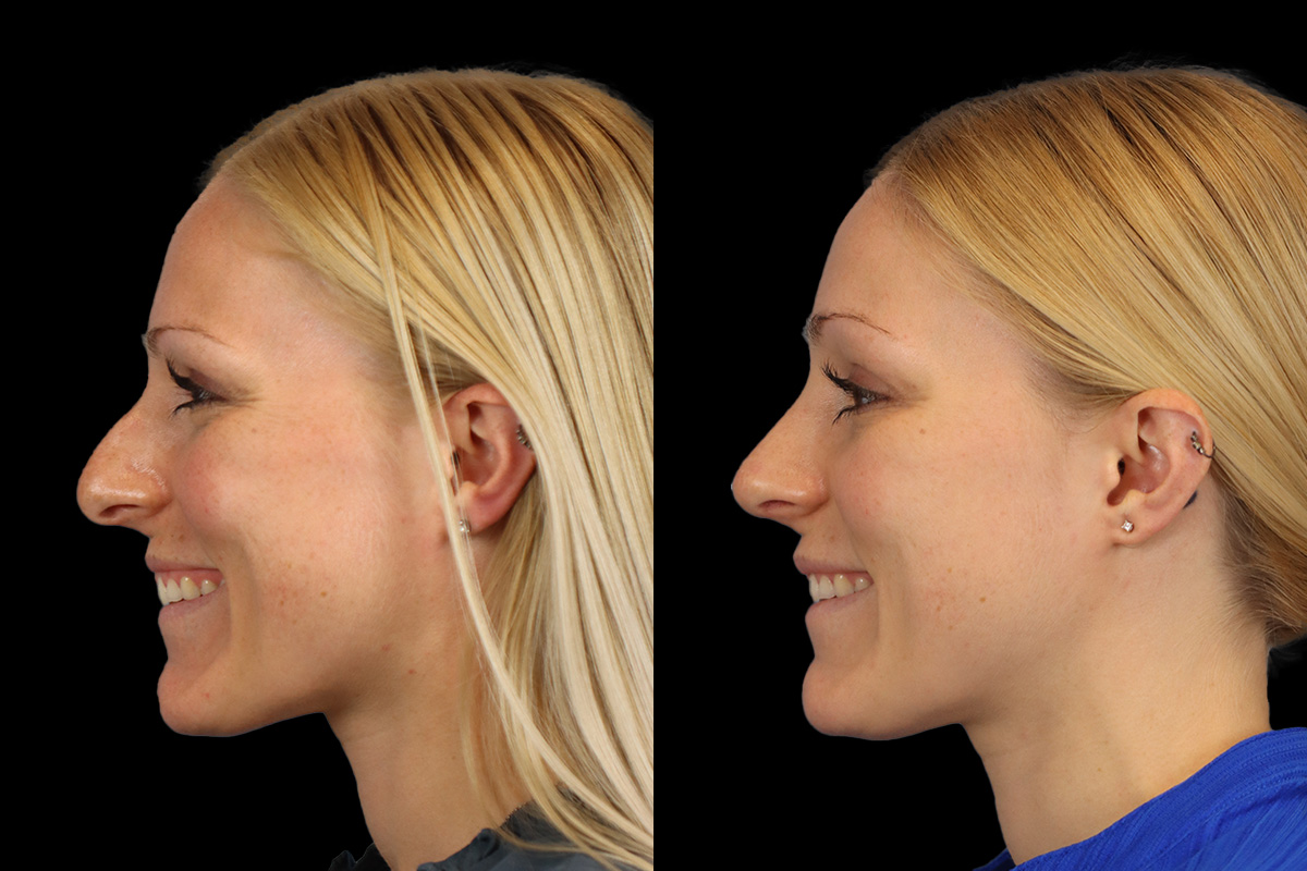Rhinoplasty Before and After | Leong Facial Plastic Surgery