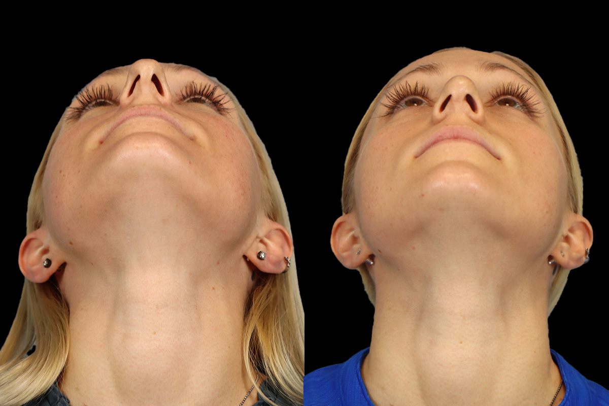 Rhinoplasty Before and After | Leong Facial Plastic Surgery