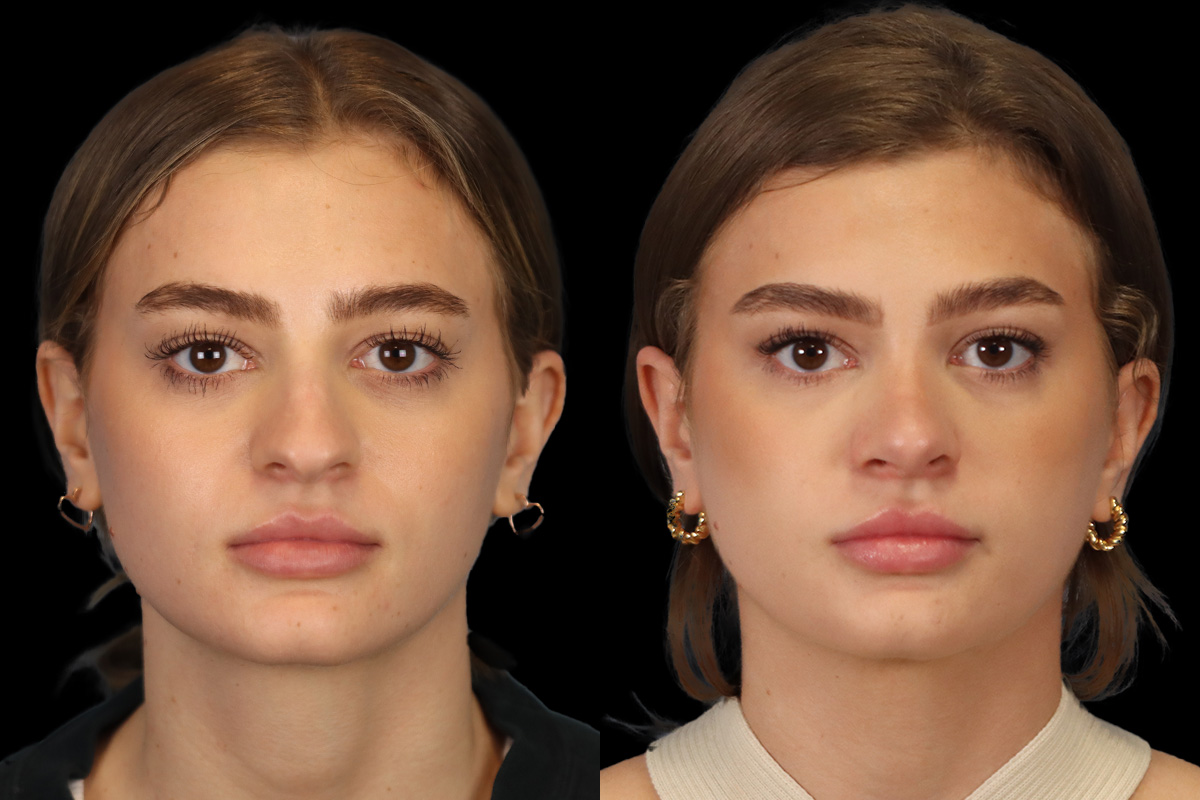 Rhinoplasty Before and After | Leong Facial Plastic Surgery