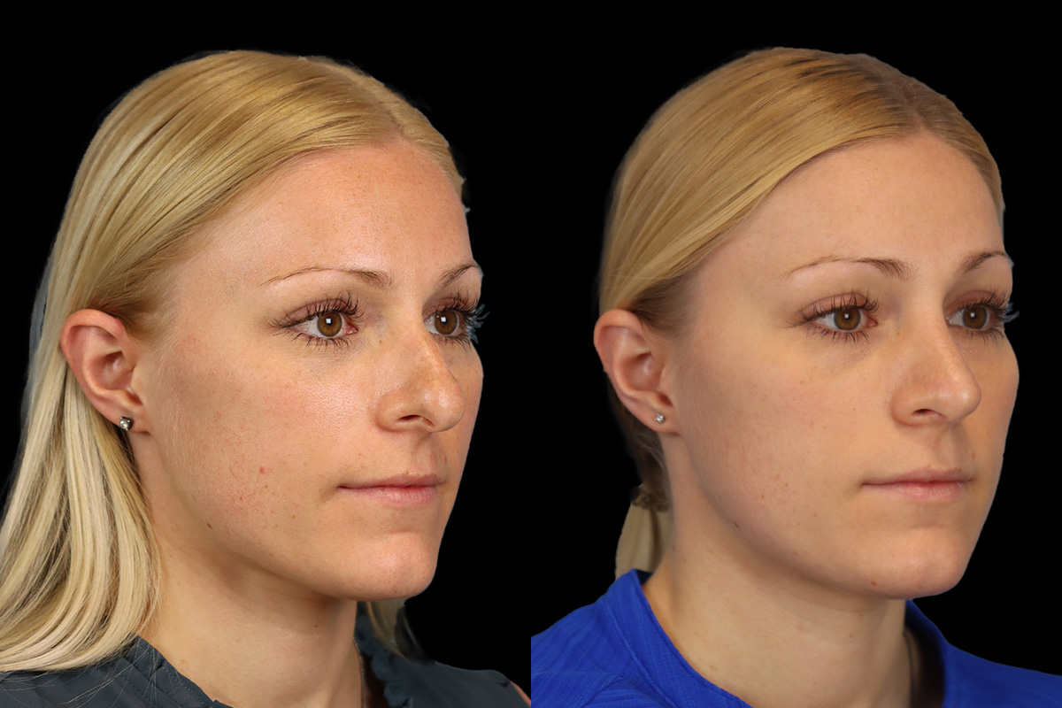 Rhinoplasty Before and After | Leong Facial Plastic Surgery