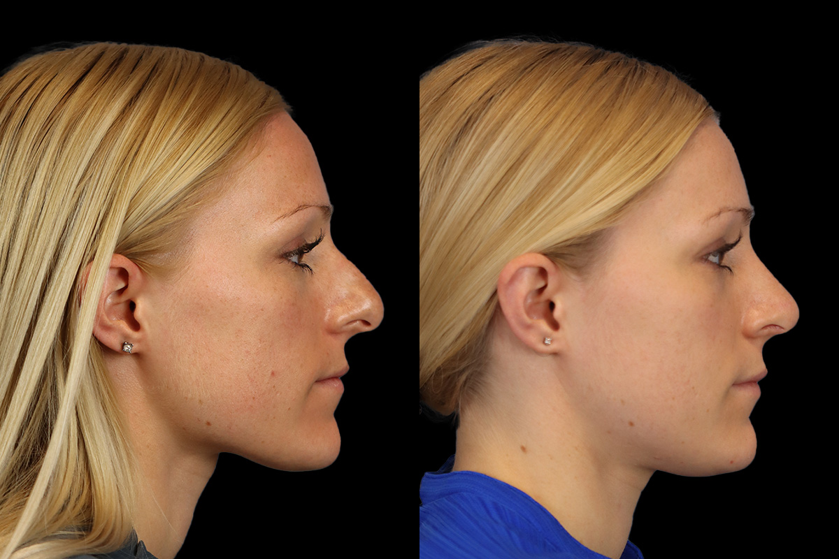 Rhinoplasty Before and After | Leong Facial Plastic Surgery
