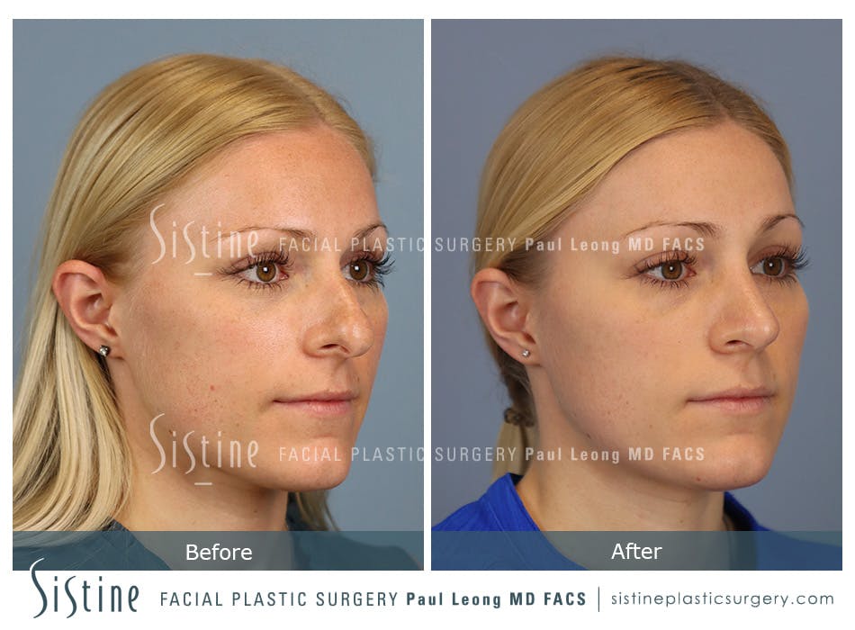 Rhinoplasty Before and After | Leong Facial Plastic Surgery