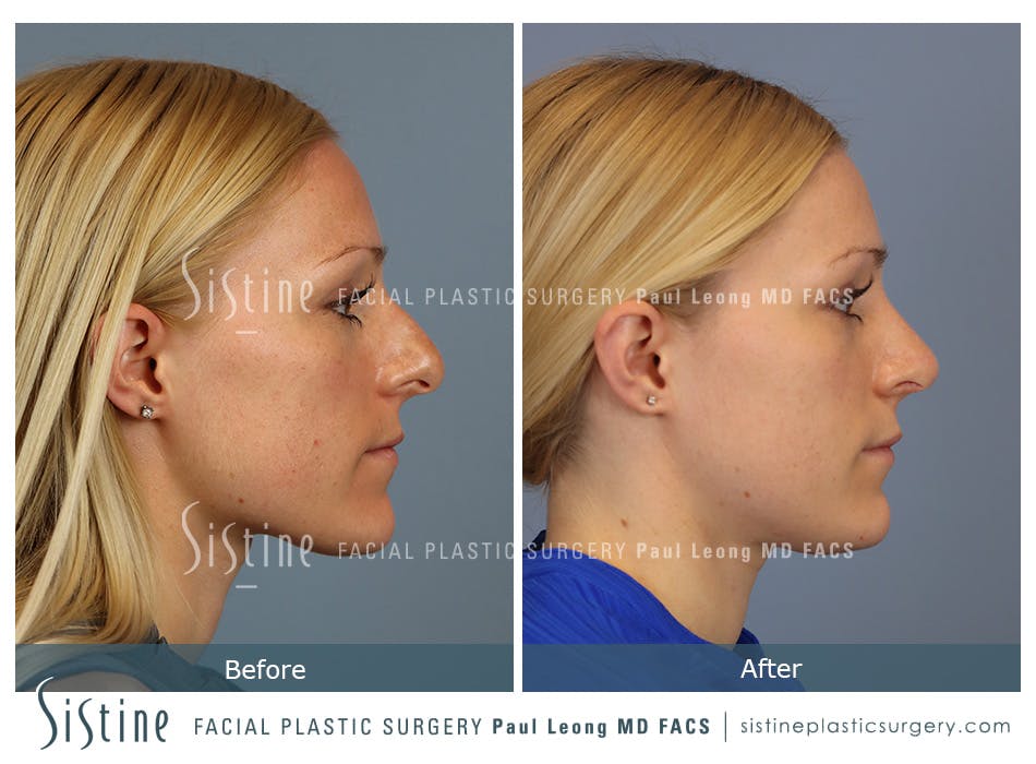 Rhinoplasty Before and After | Leong Facial Plastic Surgery