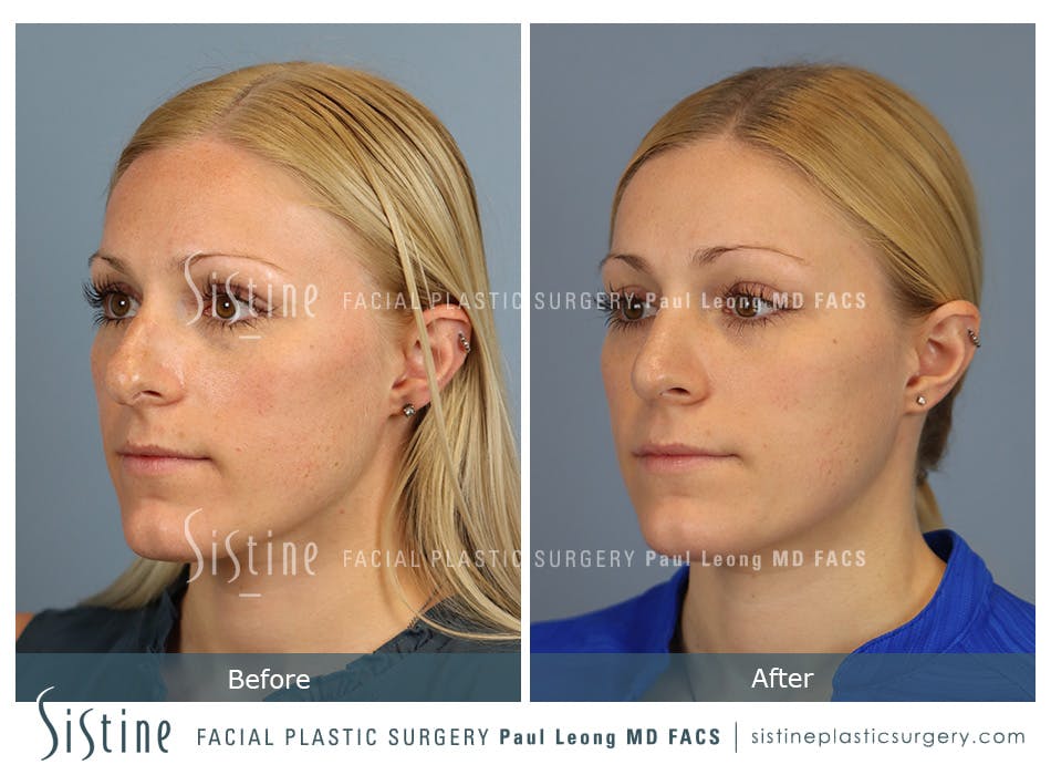 Rhinoplasty Before and After | Leong Facial Plastic Surgery