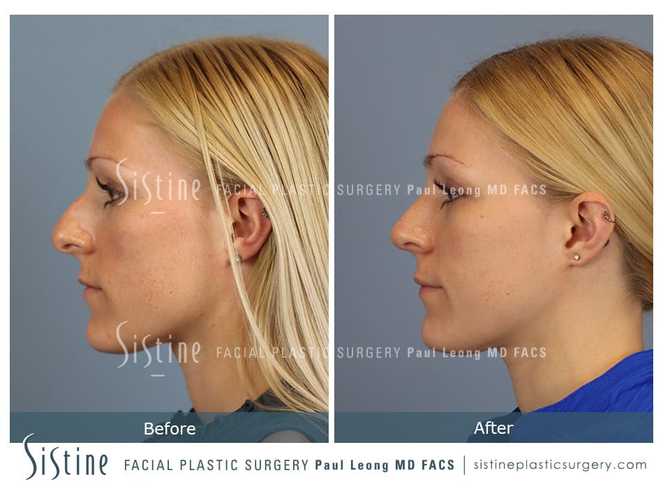 Rhinoplasty Before and After | Leong Facial Plastic Surgery