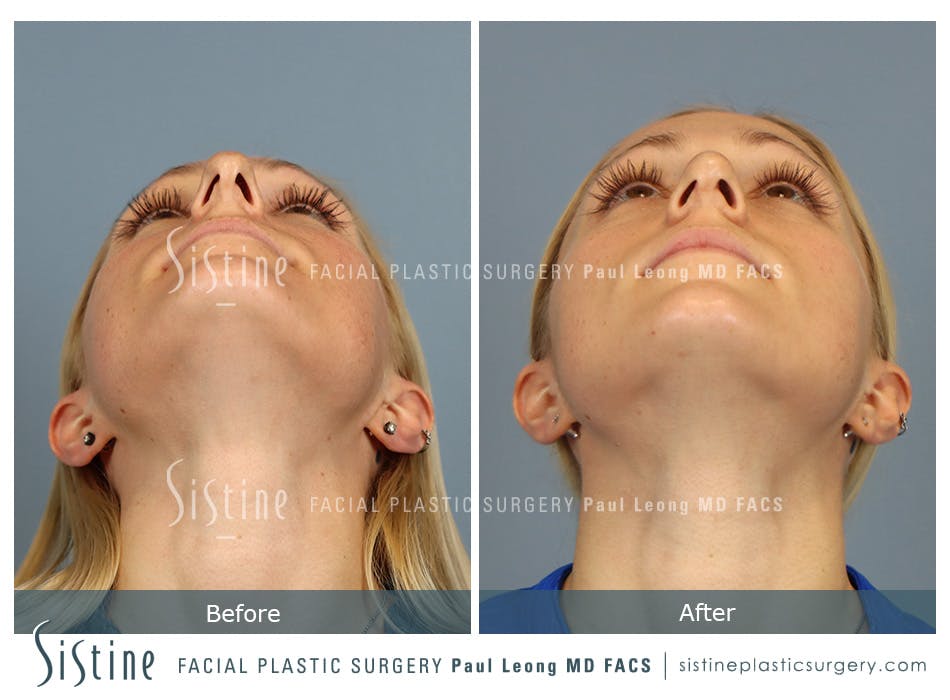 Rhinoplasty Before and After | Leong Facial Plastic Surgery