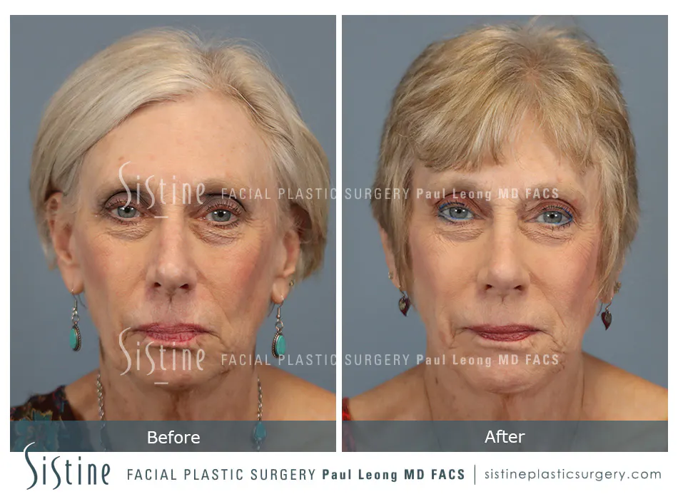 Rhinoplasty Before and After | Leong Facial Plastic Surgery