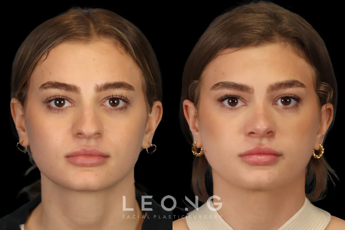 Rhinoplasty Before and After | Leong Facial Plastic Surgery