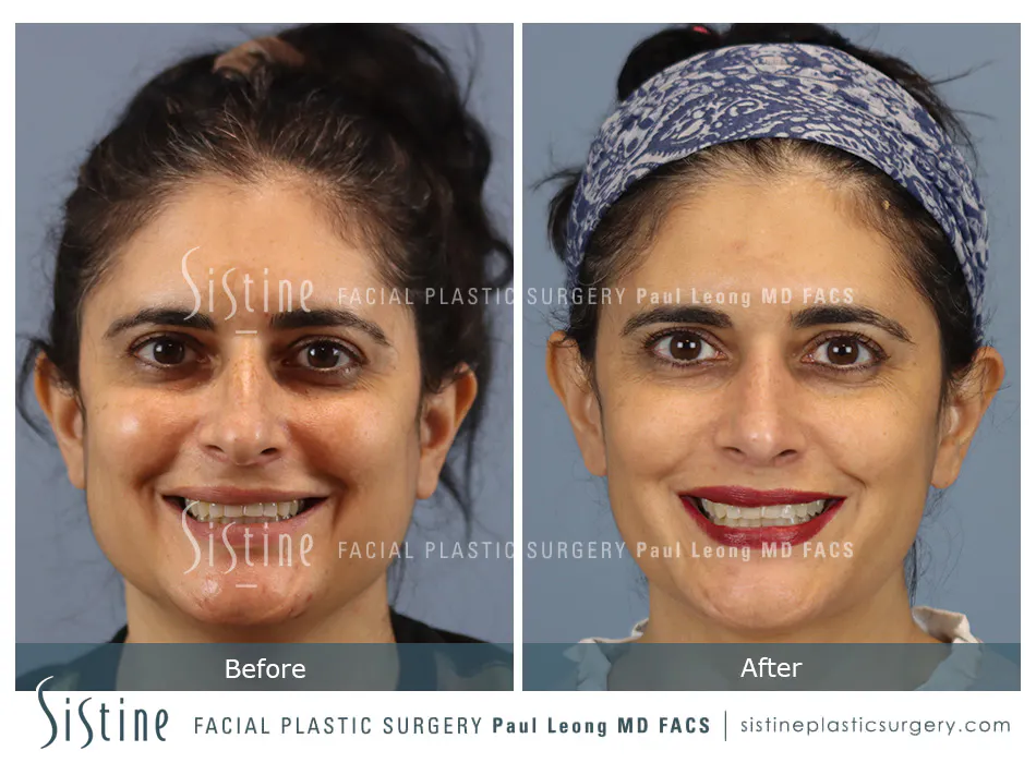 Rhinoplasty Before and After | Leong Facial Plastic Surgery