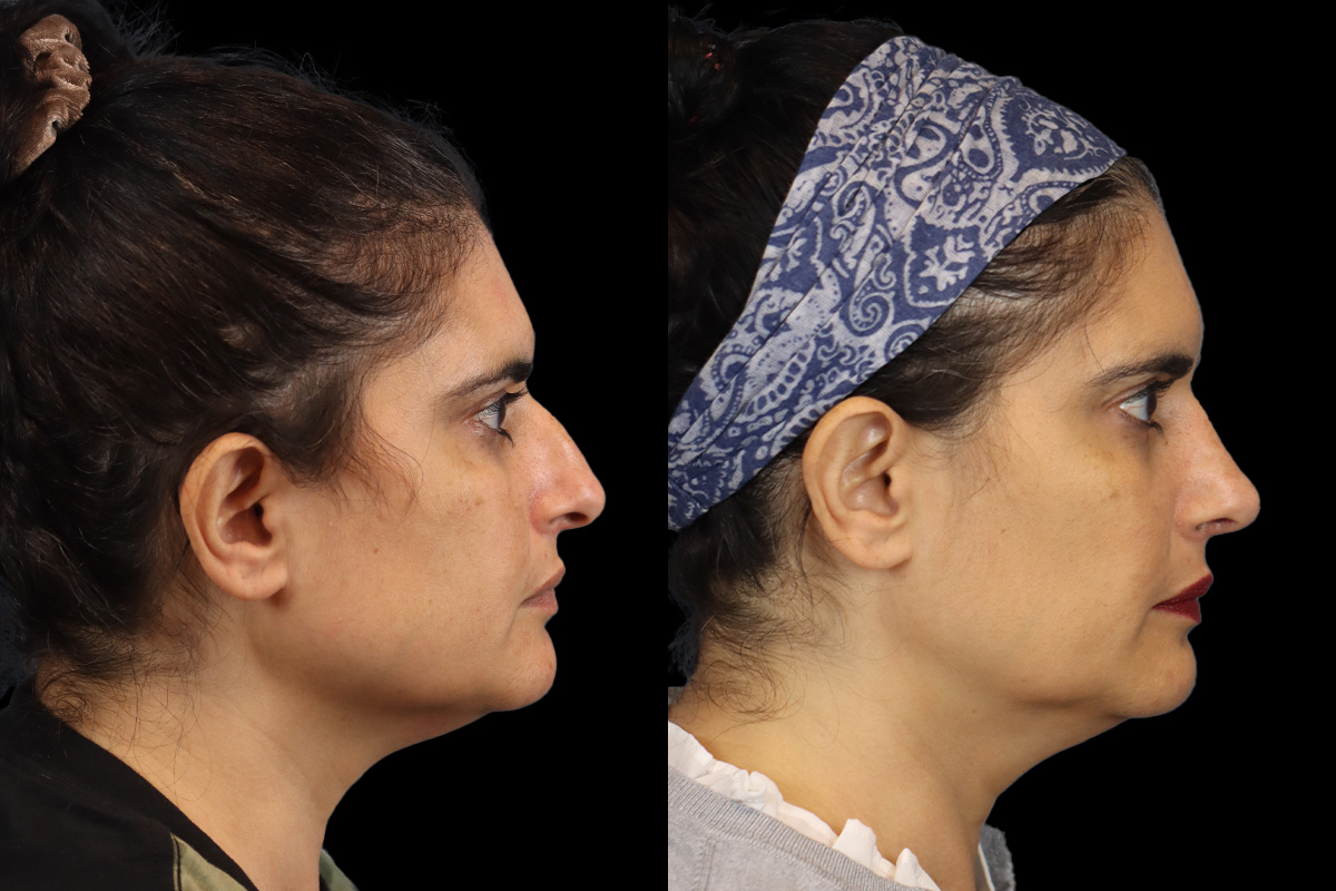 Rhinoplasty Before and After | Leong Facial Plastic Surgery