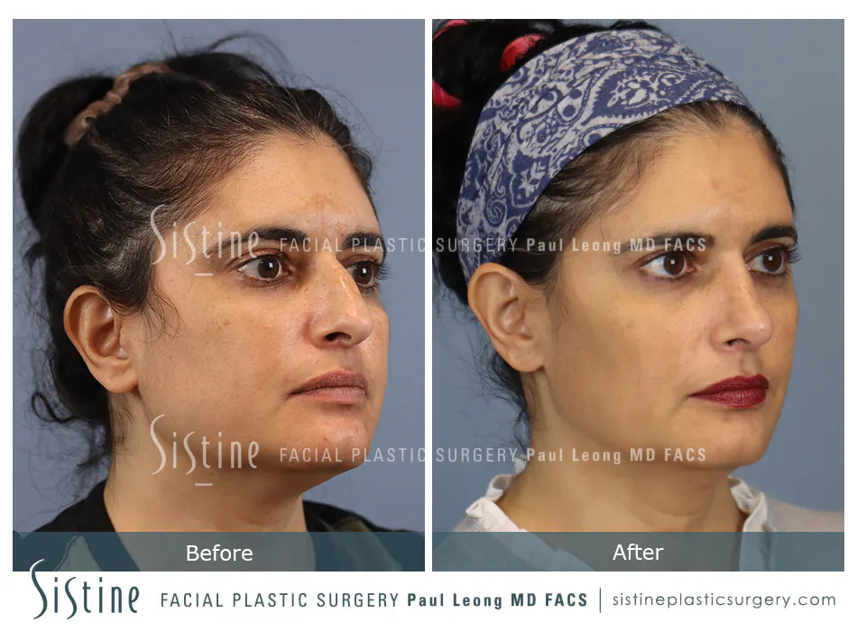 Rhinoplasty Before and After | Leong Facial Plastic Surgery