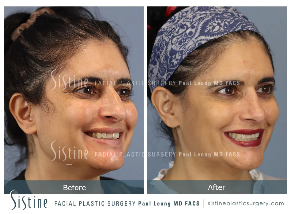 Rhinoplasty Before and After | Leong Facial Plastic Surgery