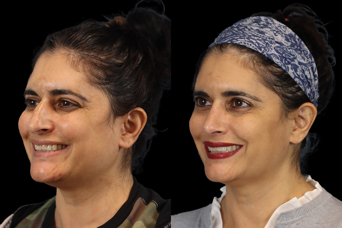 Rhinoplasty Before and After | Leong Facial Plastic Surgery