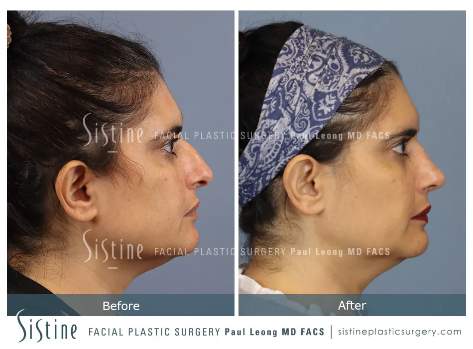 Rhinoplasty Before and After | Leong Facial Plastic Surgery