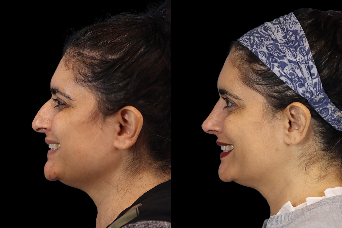Rhinoplasty Before and After | Leong Facial Plastic Surgery