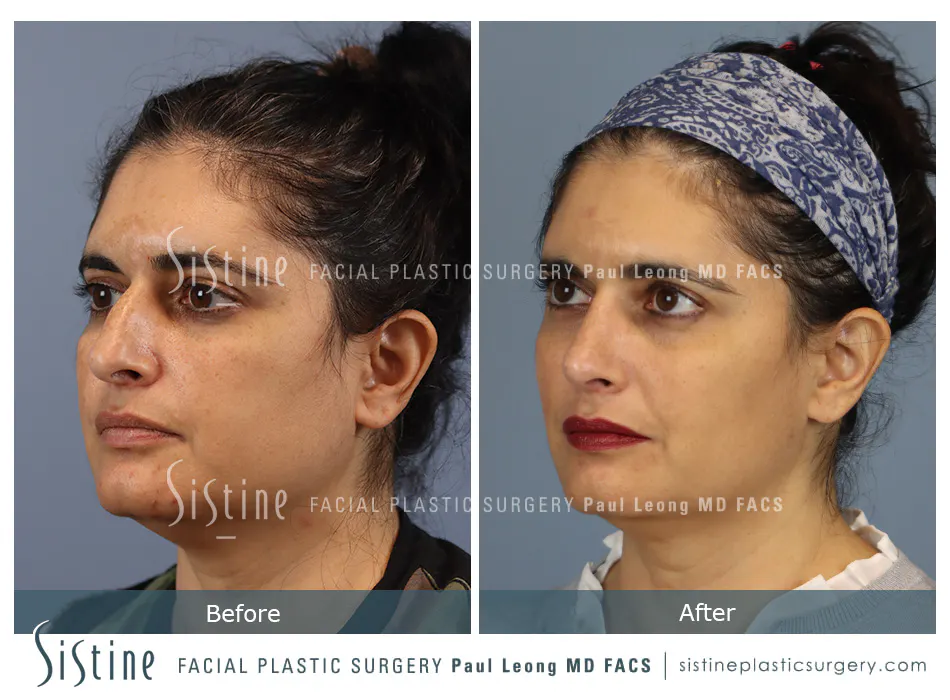 Rhinoplasty Before and After | Leong Facial Plastic Surgery