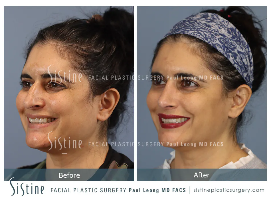 Rhinoplasty Before and After | Leong Facial Plastic Surgery