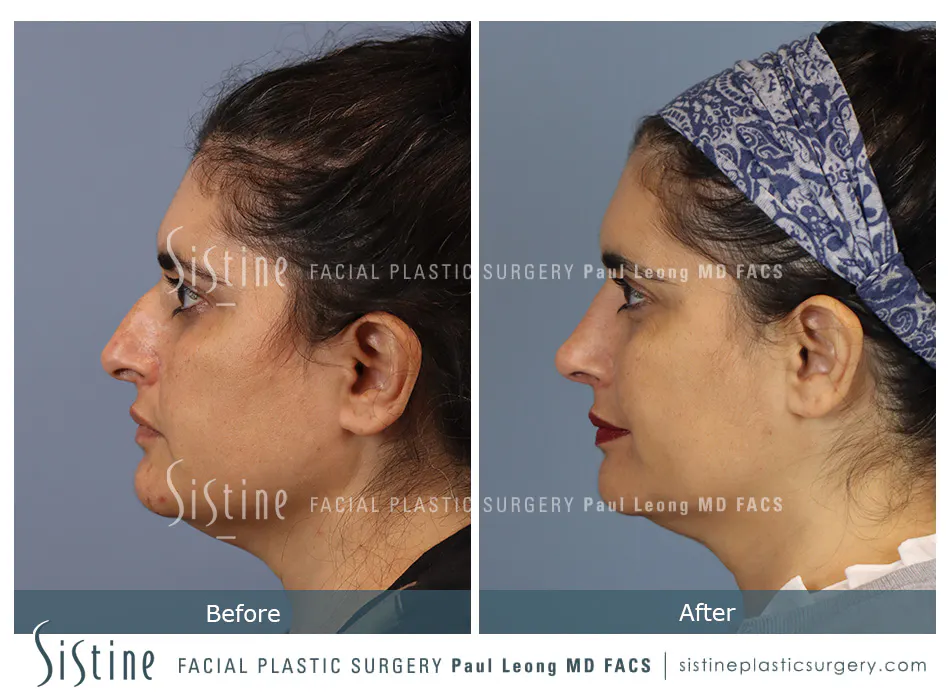 Nose Changes With Age - Preoperative View | Dr. Paul Leong