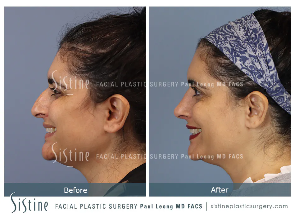 Nose Changes With Age - Preoperative View | Dr. Paul Leong