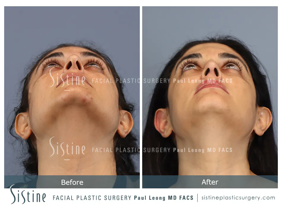 Nose Changes With Age - Preoperative View | Dr. Paul Leong