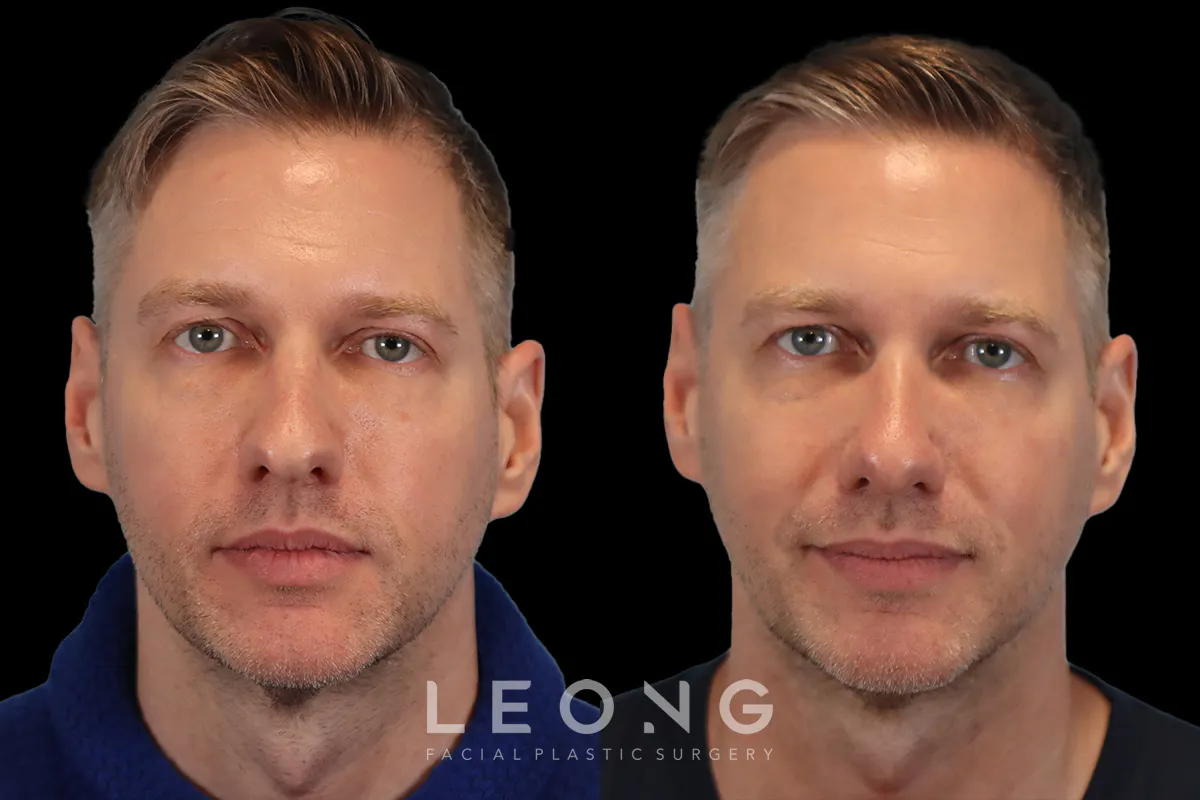 Rhinoplasty Before and After | Leong Facial Plastic Surgery