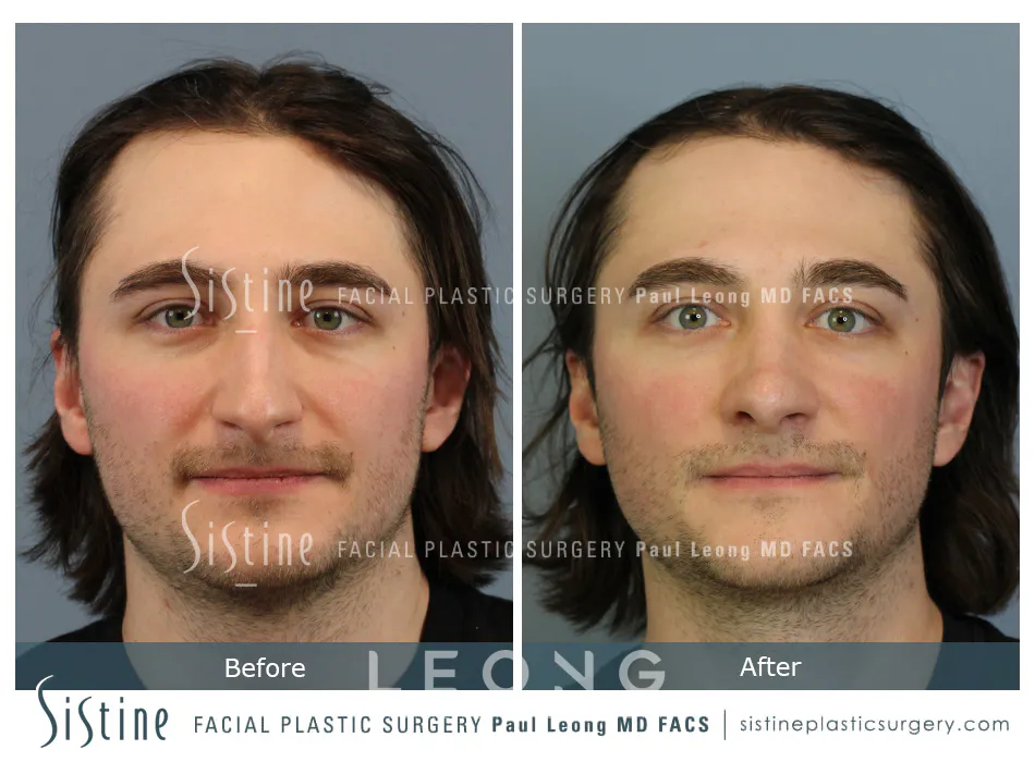 Rhinoplasty Before and After | Leong Facial Plastic Surgery