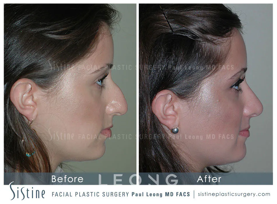Rhinoplasty Before and After | Leong Facial Plastic Surgery