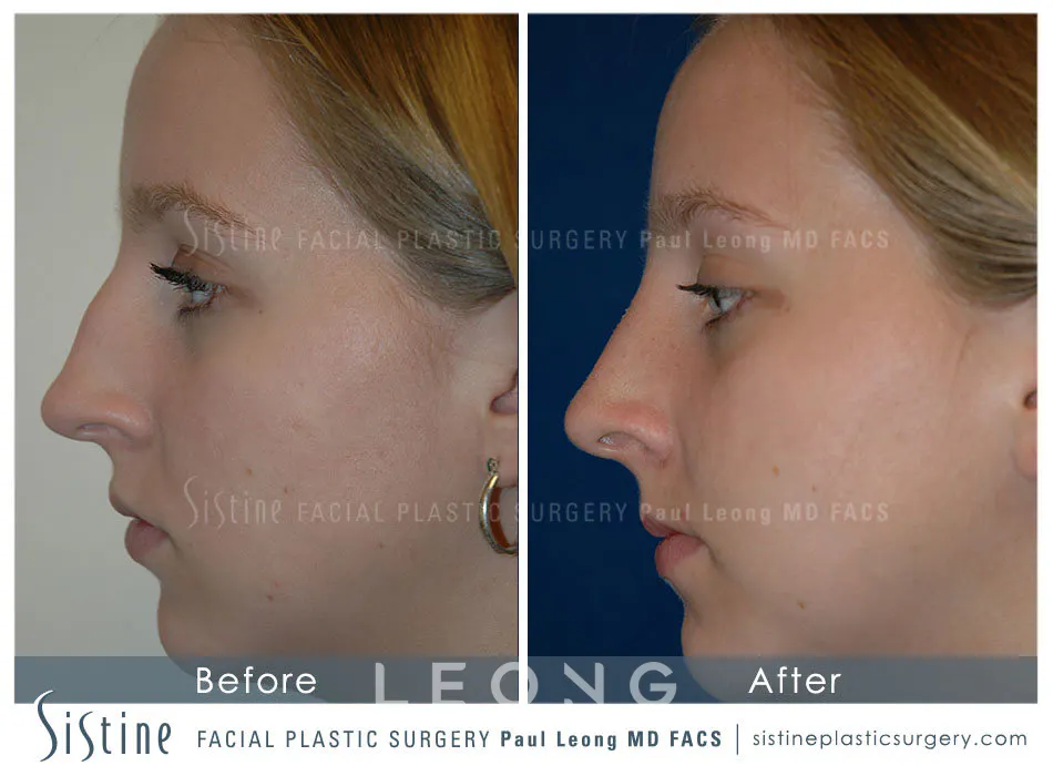 Rhinoplasty Before and After | Leong Facial Plastic Surgery