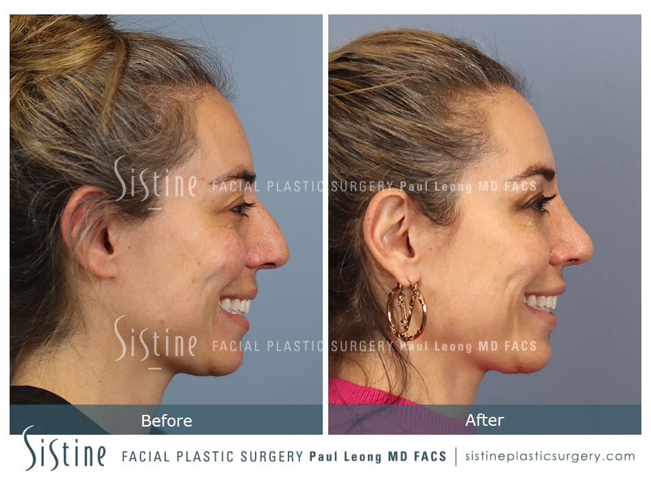 Rhinoplasty Before and After | Leong Facial Plastic Surgery