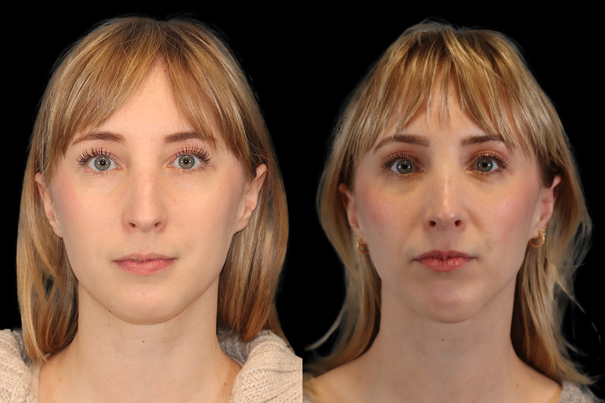 Rhinoplasty Before and After | Leong Facial Plastic Surgery
