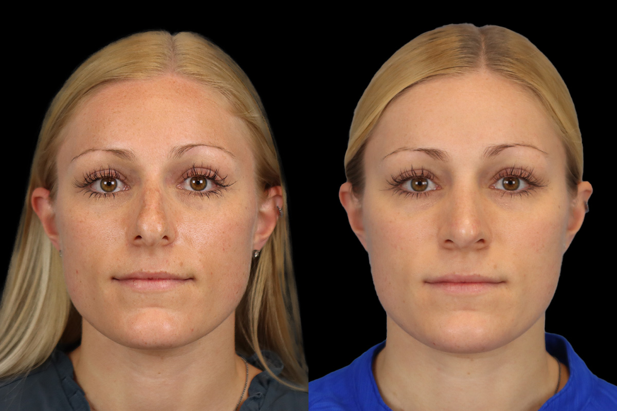 Rhinoplasty Before and After | Leong Facial Plastic Surgery