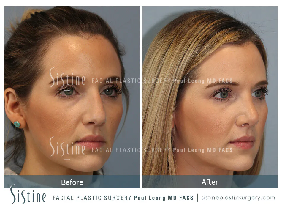 Rhinoplasty Before and After | Leong Facial Plastic Surgery