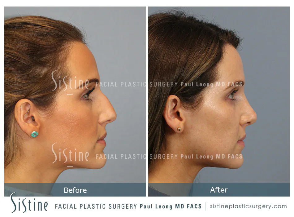 Rhinoplasty Before and After | Leong Facial Plastic Surgery