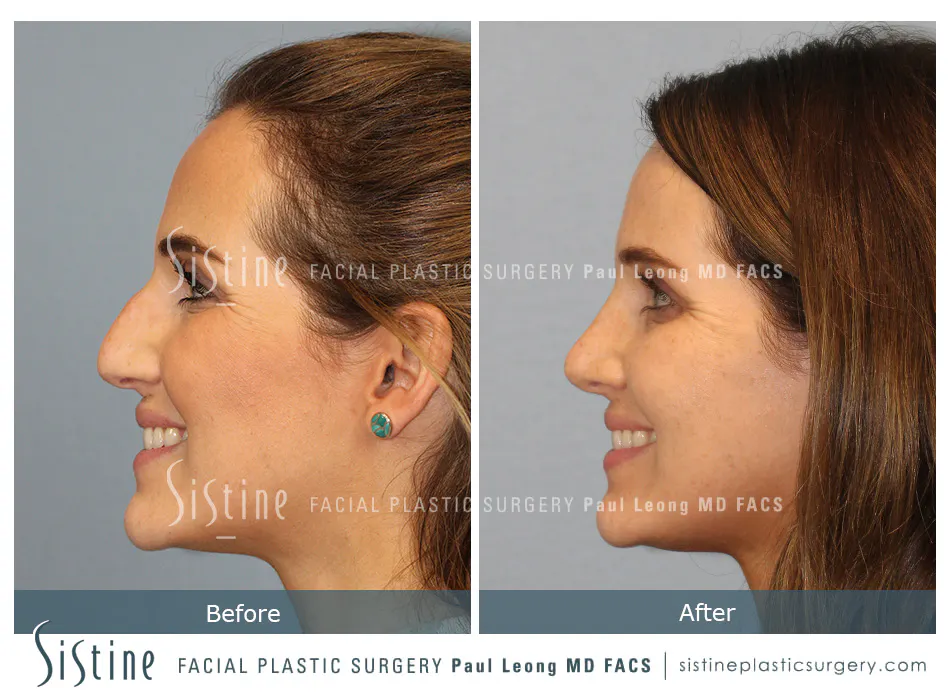 Rhinoplasty Before and After | Leong Facial Plastic Surgery
