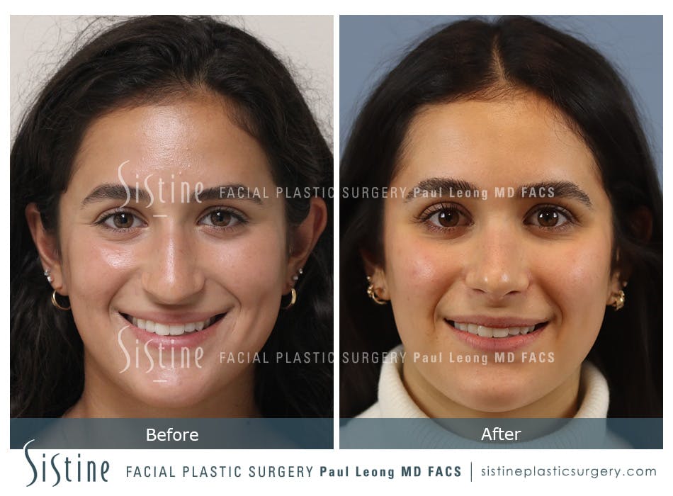 Rhinoplasty Before and After | Leong Facial Plastic Surgery