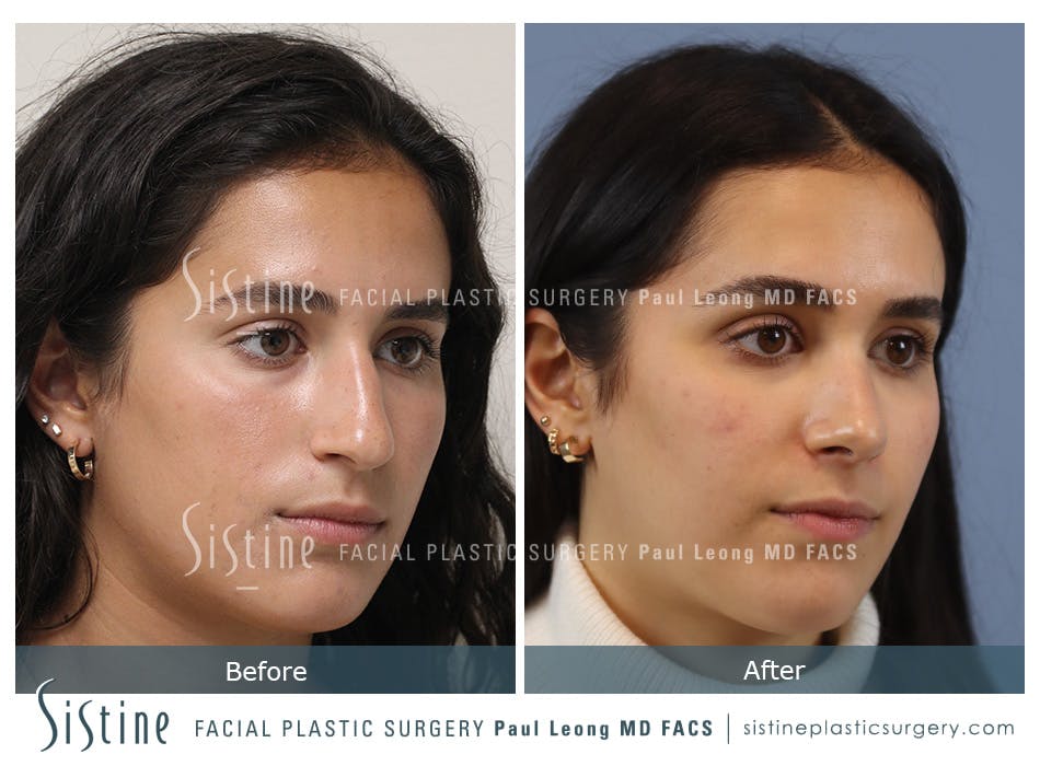Rhinoplasty Before and After | Leong Facial Plastic Surgery