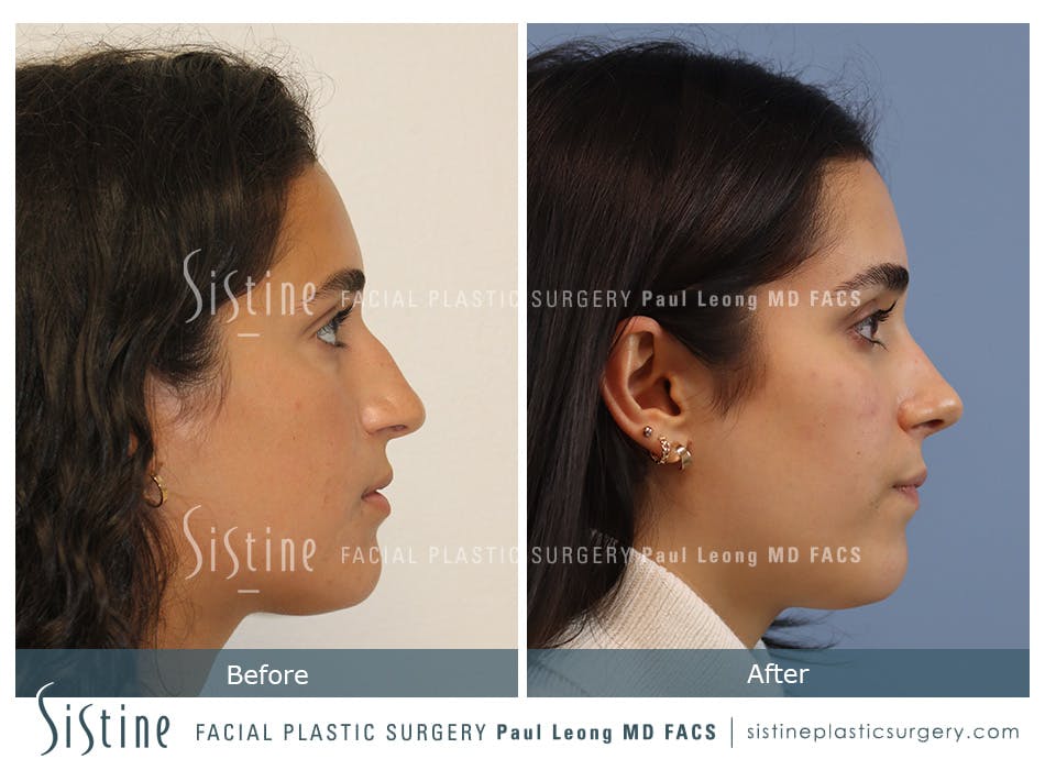 Rhinoplasty Before and After | Leong Facial Plastic Surgery